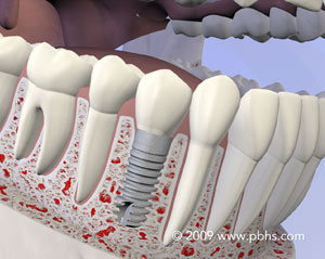 implant